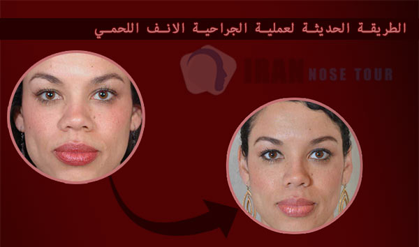 ‎الطريقة الحديثة لعملية الجراحية الانف اللحمي
