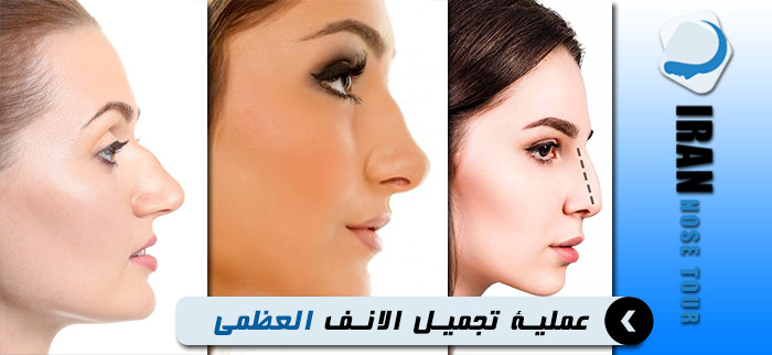 الانف العظمي