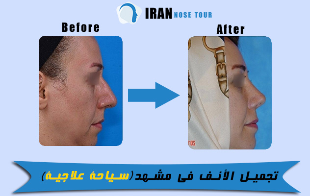الصورة قبل وبعد جراحة الأنف في مشهد