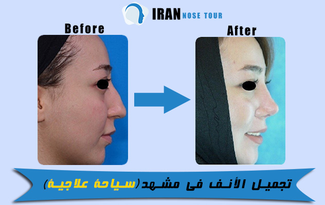 تجميل الأنف في مشهد before after
