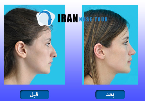 جراحة أنف العظمي قبل و بعد صور