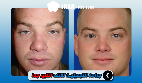 جراحة الأنف التجميلية الكبيرة
