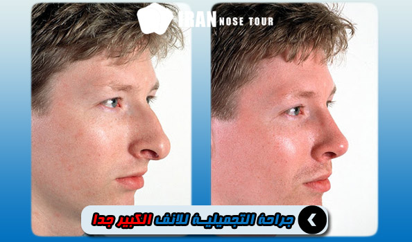 قبل وبعد عملية تجميل الأنف الكبير