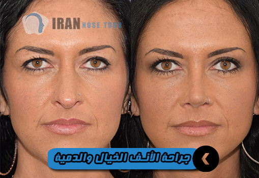 جراحة الأنف الدمية