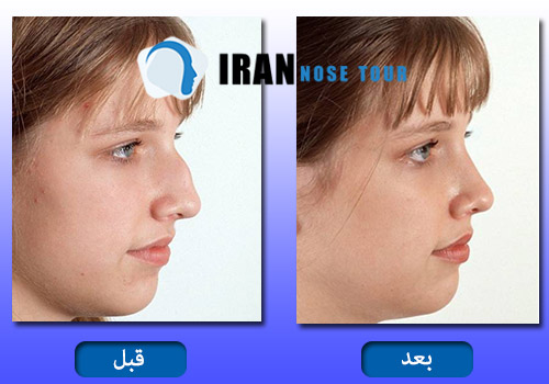 عملية تجميل الانف العظمي