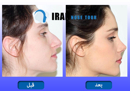قبل و بعد تجميل الانف