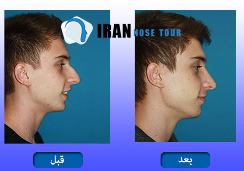 قبل و بعد عملية تجميل الانف العظمي