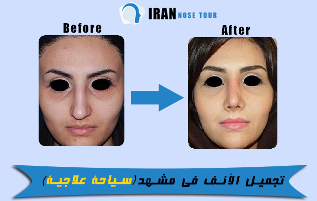 قبل وبعد تجميل الأنف في مشهد