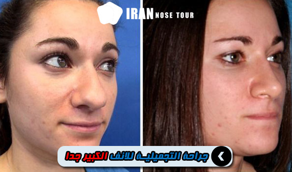 قبل وبعد جراحة الأنف التجميلية الكبيرة