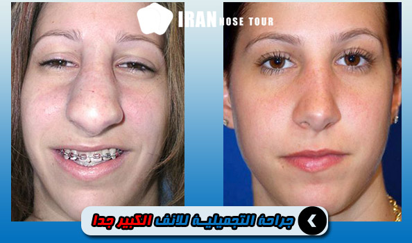 قبل وبعد جراحة الأنف التجميلية الكبيرة