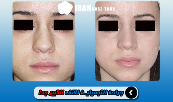 قبل وبعد جراحة الأنف التجميلية الكبيرة