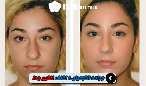 قبل وبعد جراحة الأنف التجميلية الكبيرة