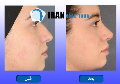 قبل وبعد جراحة الأنف العظمية