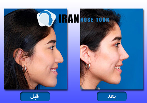 قبل وبعد صور جراحة الأنف العظمية